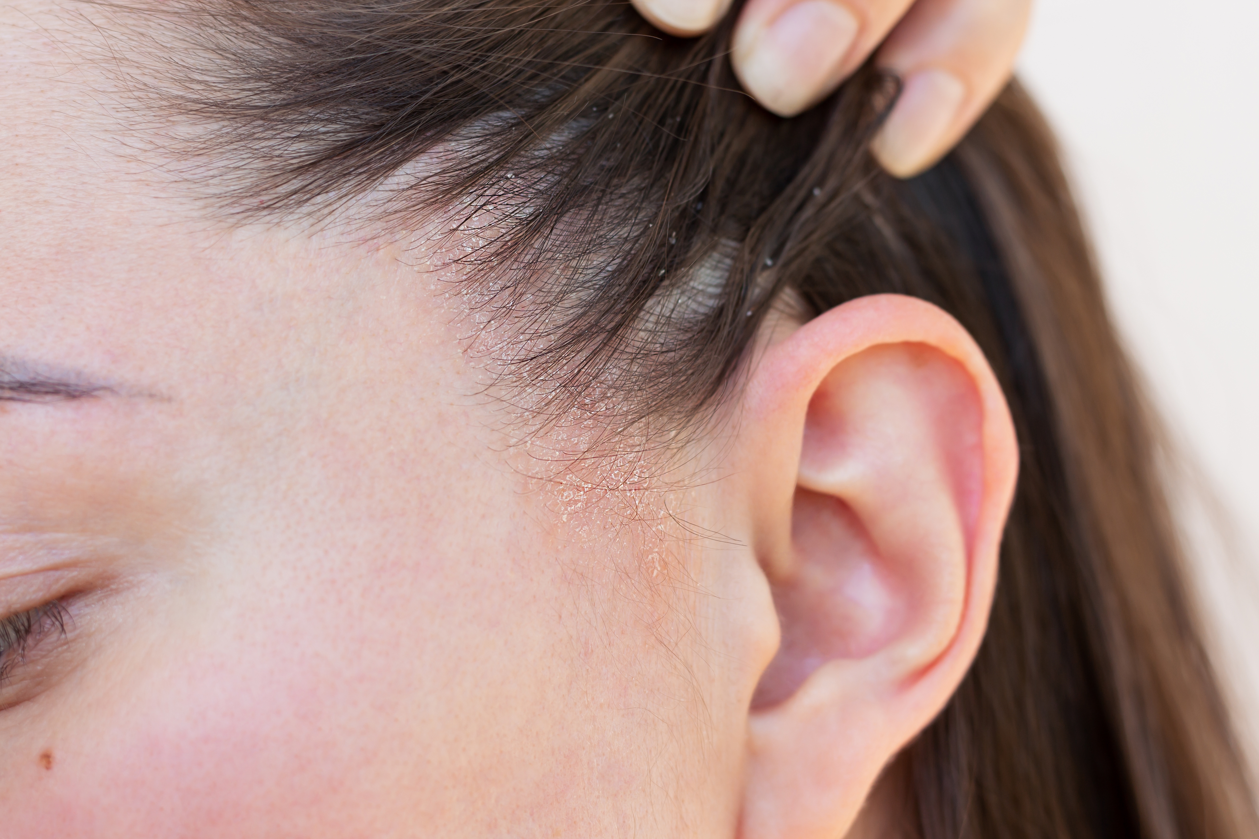 Seboreik Dermatit Nedir?